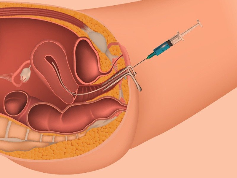 Everything You Need to Know about IUI vs. IVF: Which One Fits ...